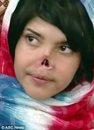 afghan-woman-whose-husband-and-father-cut-off-her-nose-and-face-for-running-away-from-marriage-name-is-aisha.jpg